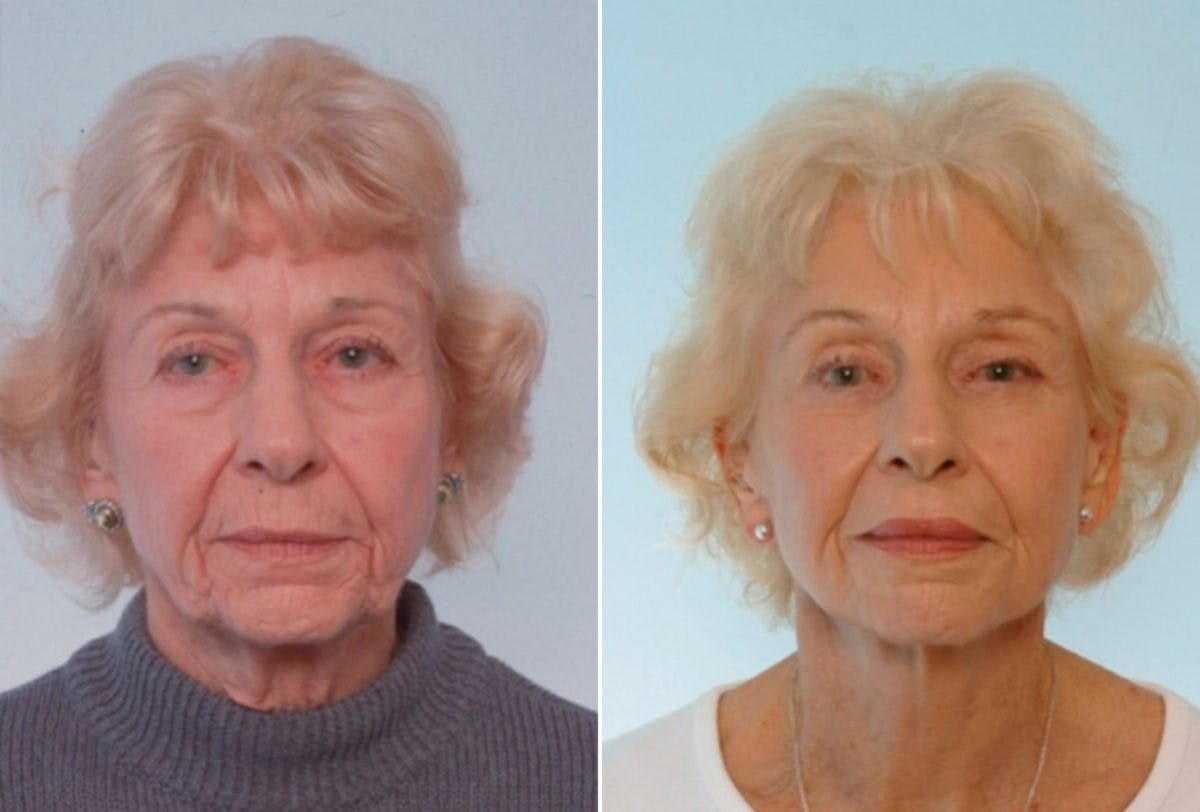 Blepharoplasty Before & After Gallery - Patient 55114291 - Image 1