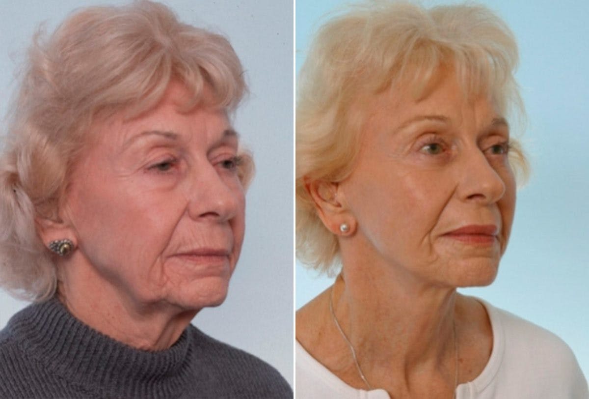 Blepharoplasty Before & After Photo - Patient 55114291 - Image 2