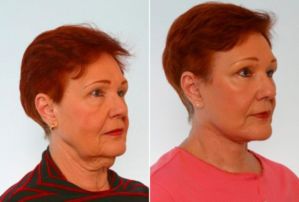 Blepharoplasty Before & After Gallery - Patient 55119173 - Image 2