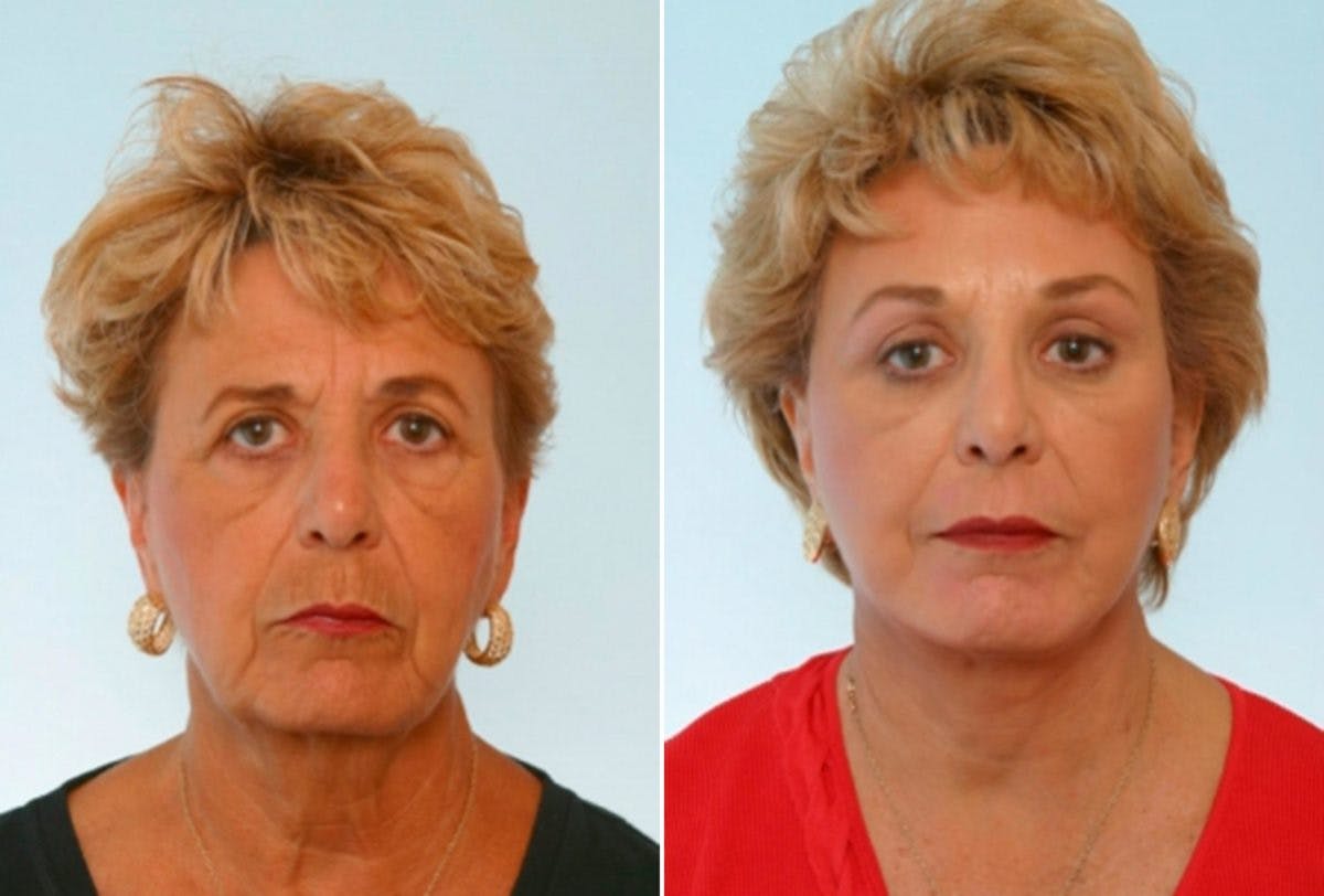 Blepharoplasty Before & After Gallery - Patient 55119174 - Image 1