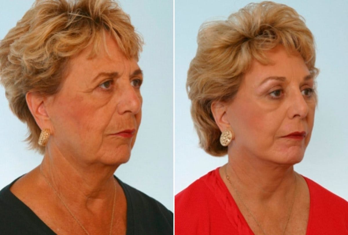 Blepharoplasty Before & After Gallery - Patient 55119174 - Image 2