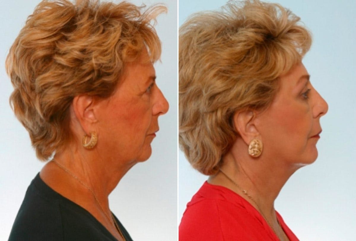 Blepharoplasty Before & After Gallery - Patient 55119174 - Image 3