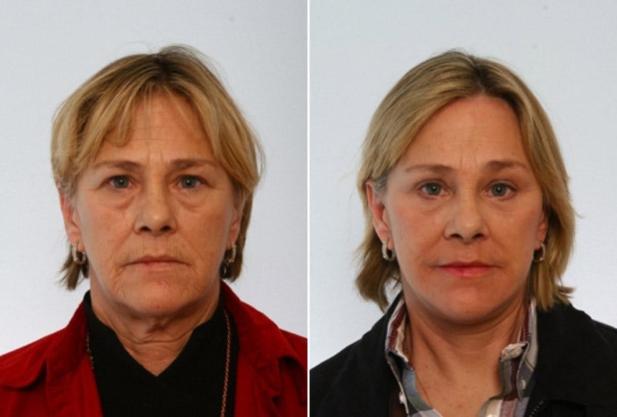 Blepharoplasty Before & After Gallery - Patient 55119175 - Image 1