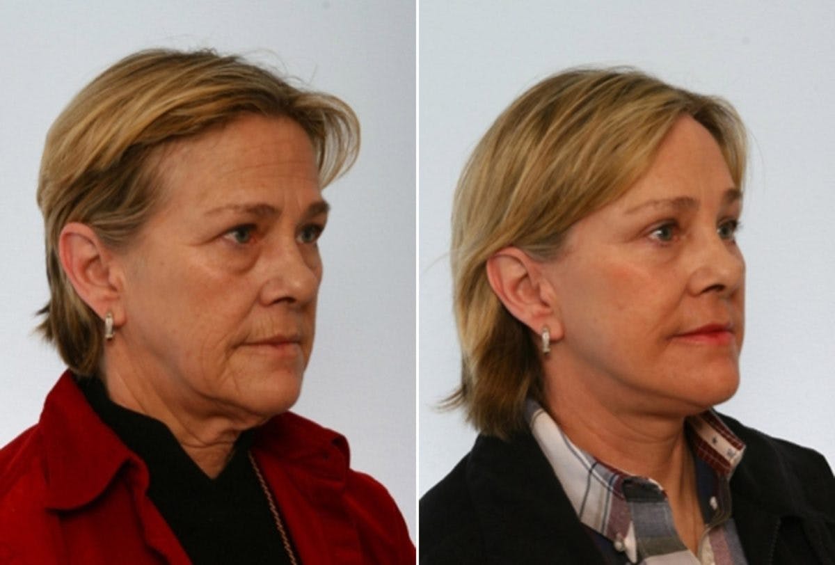 Blepharoplasty Before & After Gallery - Patient 55119175 - Image 2