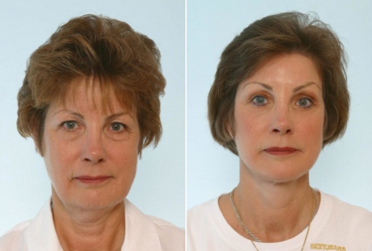 Blepharoplasty Before & After Gallery - Patient 55119176 - Image 1