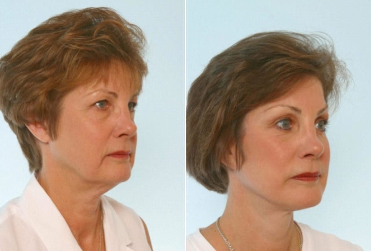 Blepharoplasty Before & After Gallery - Patient 55119176 - Image 2
