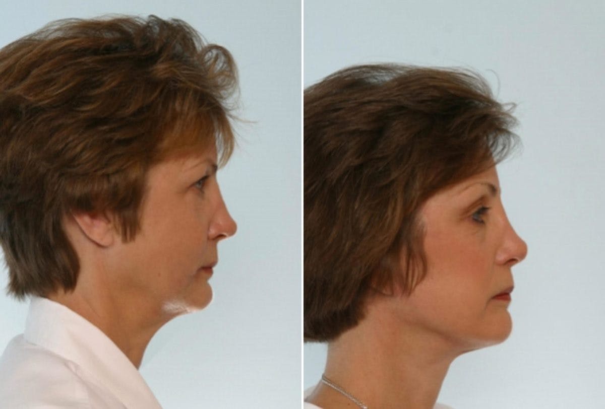 Blepharoplasty Before & After Gallery - Patient 55119176 - Image 3