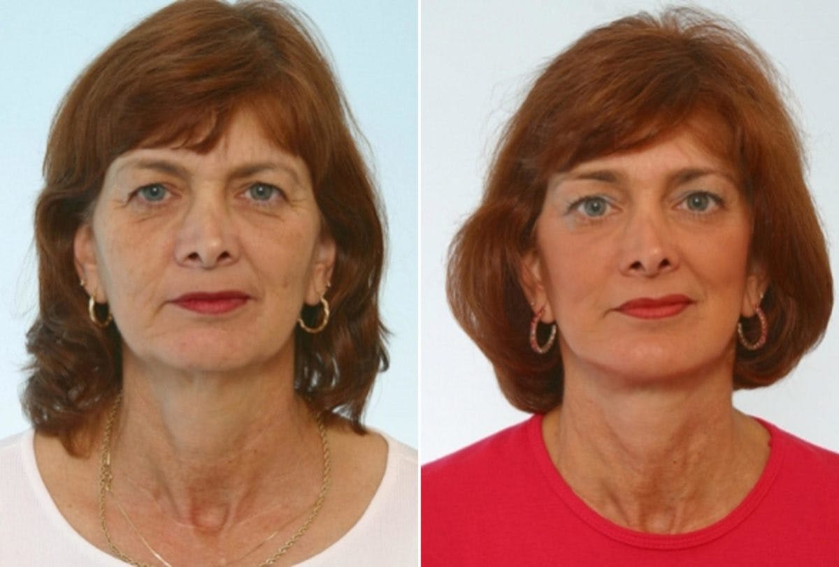 Blepharoplasty Before & After Gallery - Patient 55119177 - Image 1