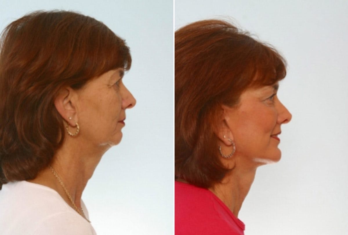 Blepharoplasty Before & After Photo - Patient 55119177 - Image 3