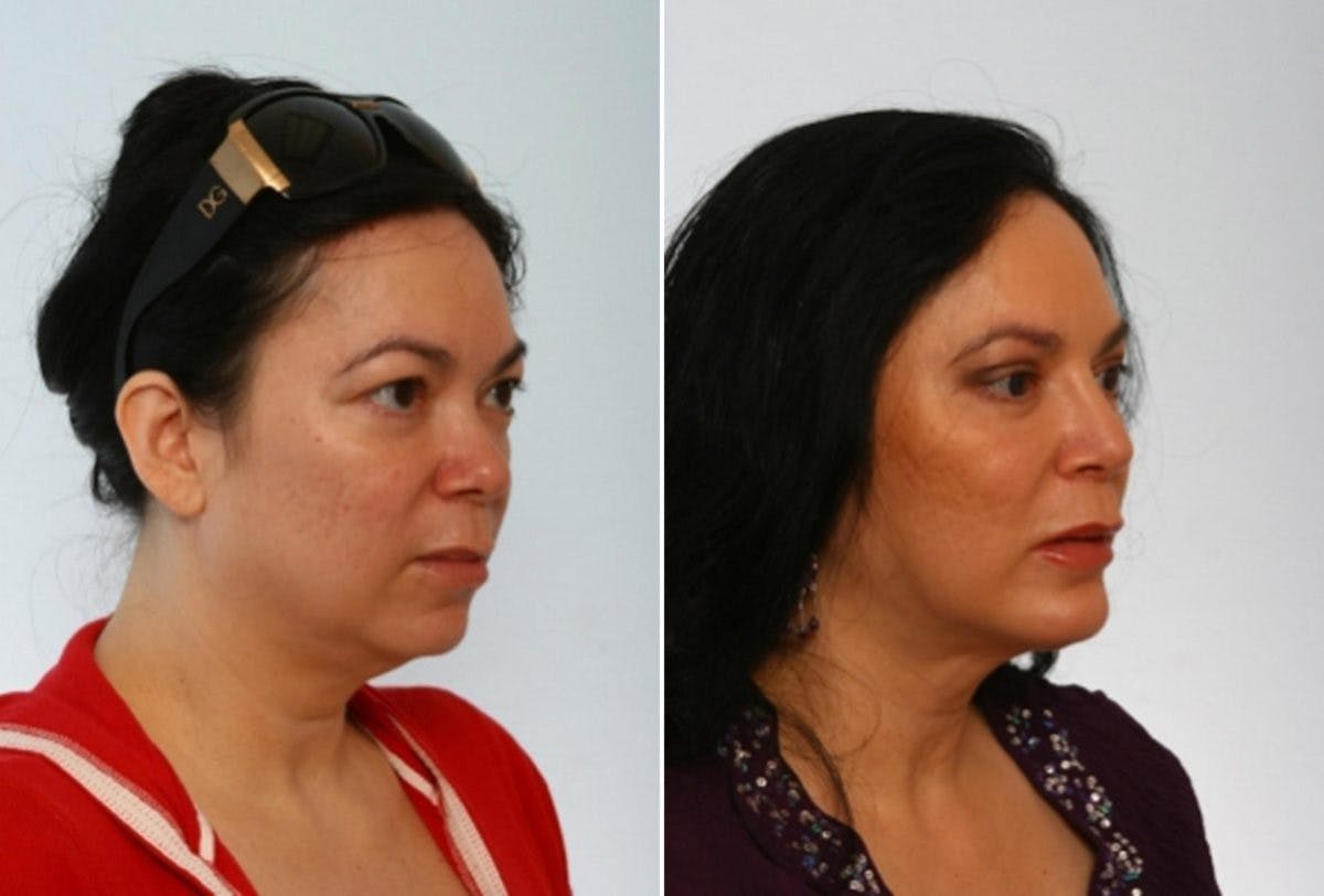 Blepharoplasty Before & After Gallery - Patient 55119180 - Image 2