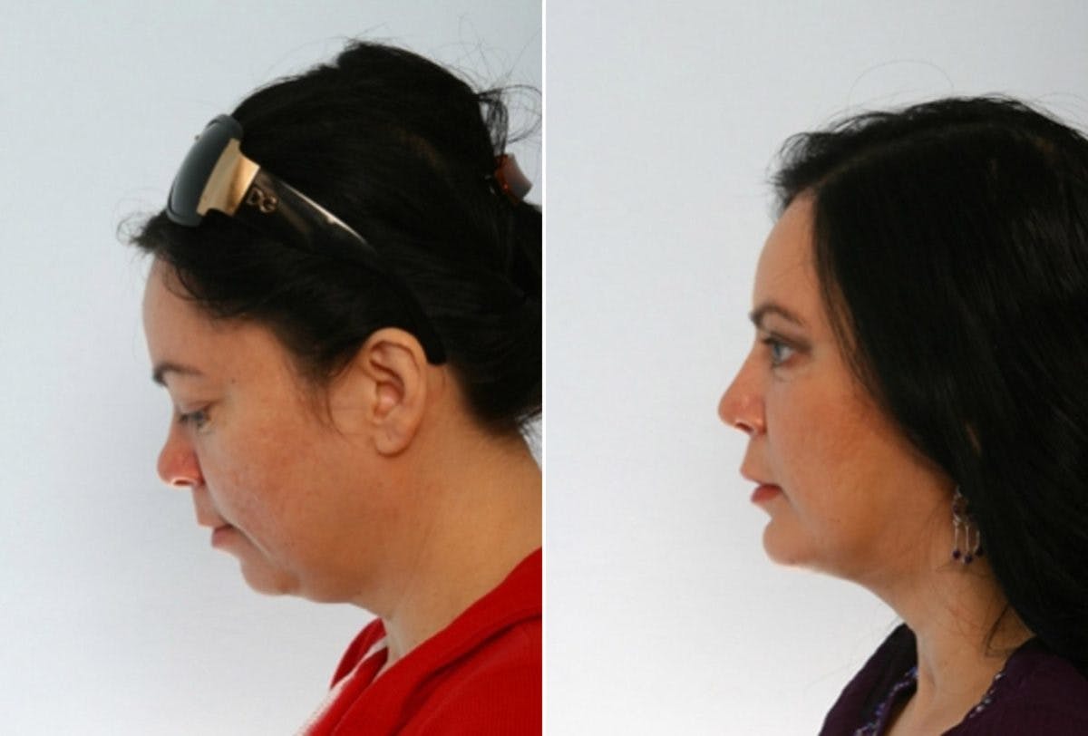 Blepharoplasty Before & After Gallery - Patient 55119180 - Image 5