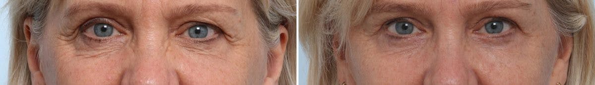 Blepharoplasty Before & After Photo - Patient 55119182 - Image 1