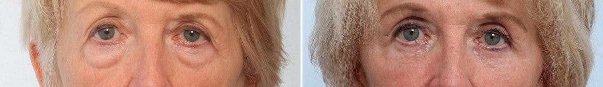 Blepharoplasty Before & After Gallery - Patient 55119184 - Image 1