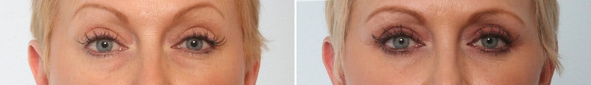 Blepharoplasty Before & After Gallery - Patient 55119185 - Image 1