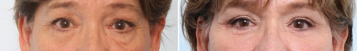 Blepharoplasty Before & After Gallery - Patient 55119188 - Image 1