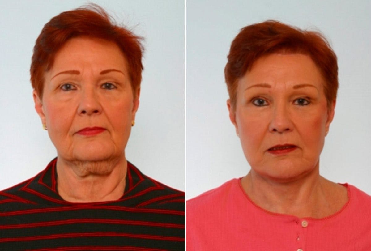 Facelift Before & After Photo - Patient 55119235 - Image 1