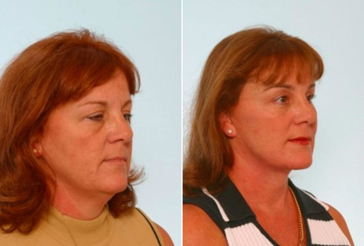 Facelift Before & After Gallery - Patient 55119236 - Image 2