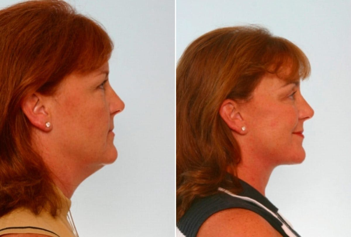 Facelift Before & After Gallery - Patient 55119236 - Image 3