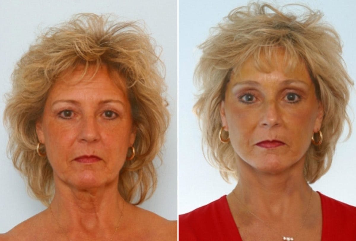 Facelift Before & After Gallery - Patient 55119237 - Image 1