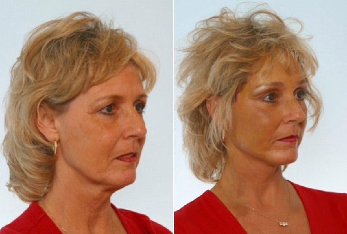 Facelift Before & After Gallery - Patient 55119237 - Image 2