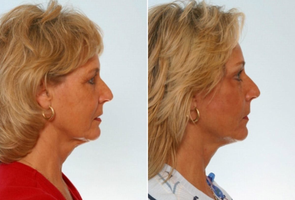 Facelift Before & After Gallery - Patient 55119237 - Image 3