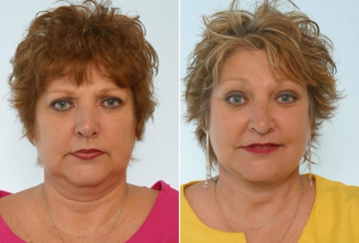 Facelift Before & After Gallery - Patient 55119238 - Image 1