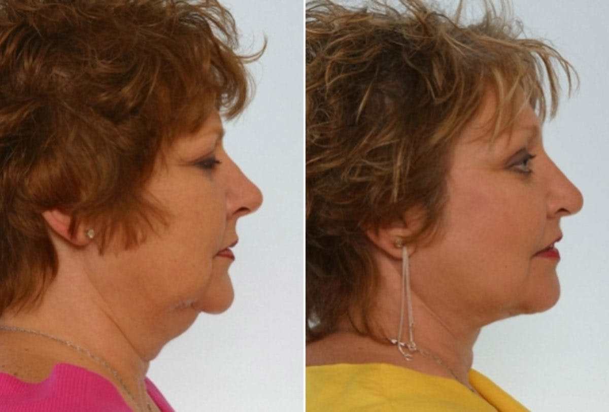 Facelift Before & After Gallery - Patient 55119238 - Image 3