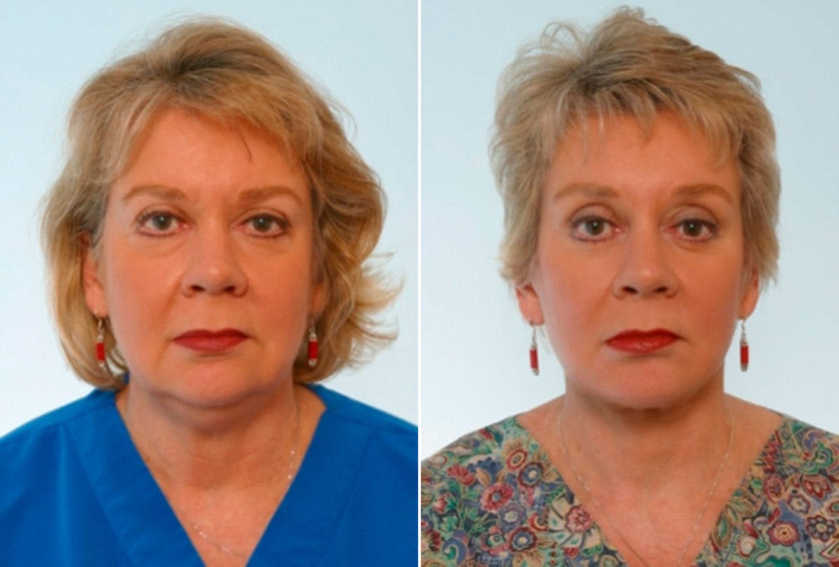 Facelift Before & After Gallery - Patient 55119245 - Image 1