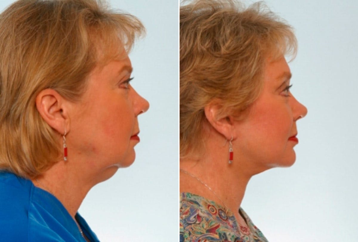 Facelift Before & After Photo - Patient 55119245 - Image 3