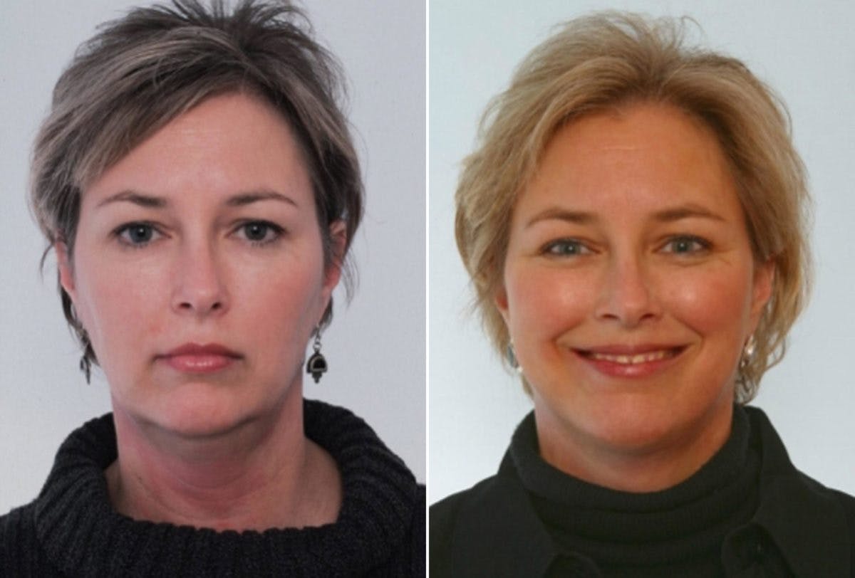 Neck Lift Before & After Gallery - Patient 55510957 - Image 1