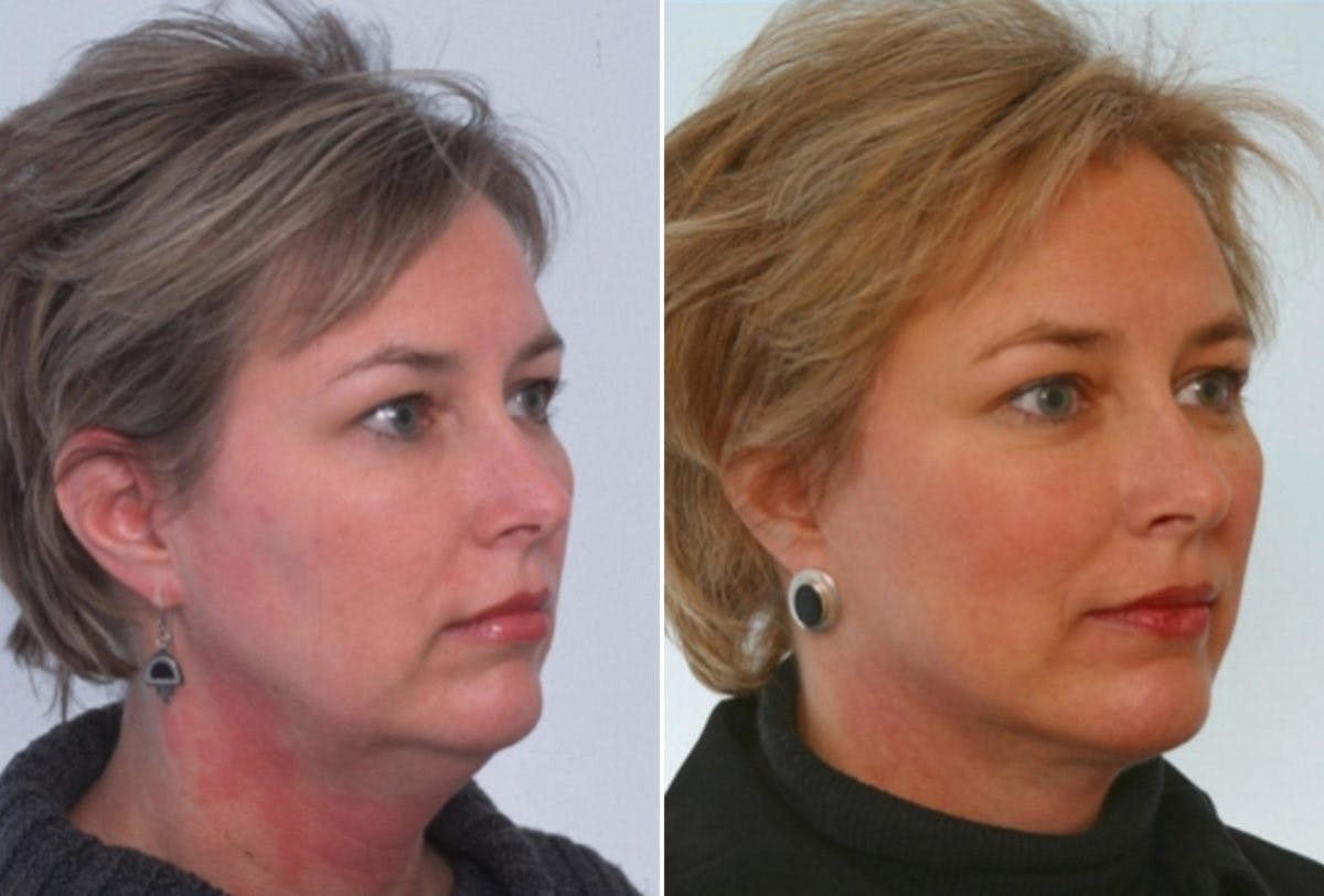 Neck Lift Before & After Gallery - Patient 55510957 - Image 2