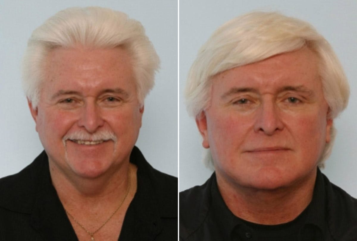 Facelift Before & After Gallery - Patient 55119247 - Image 1