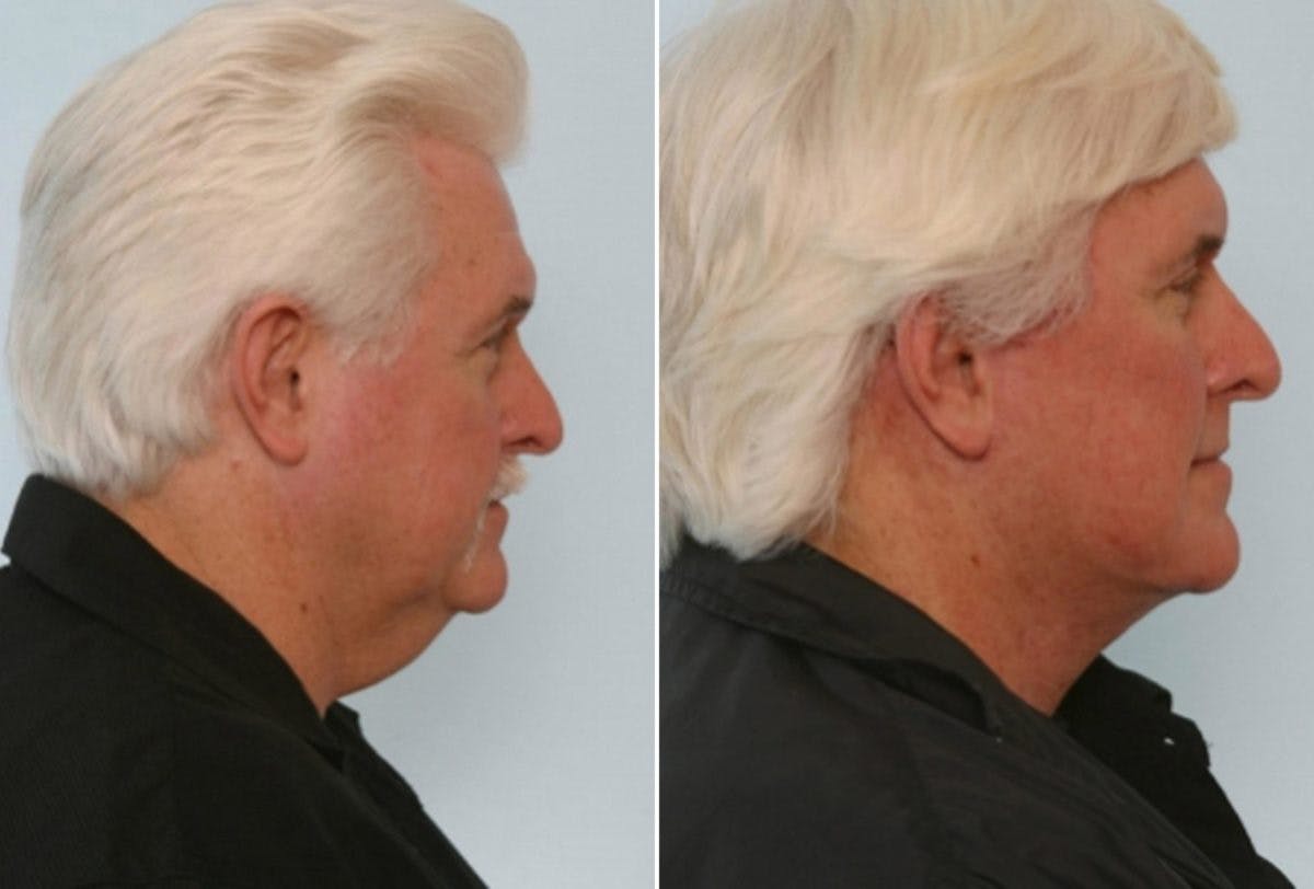 Facelift Before & After Gallery - Patient 55119247 - Image 3