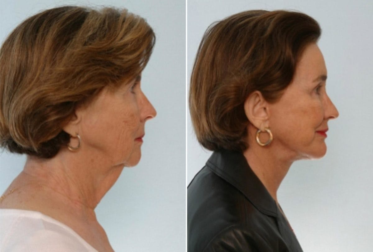 Facelift Before & After Gallery - Patient 55119248 - Image 3