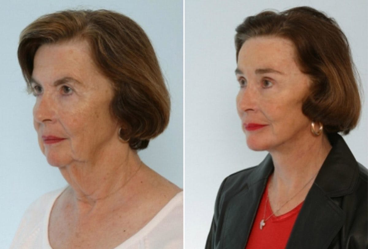 Facelift Before & After Gallery - Patient 55119248 - Image 4