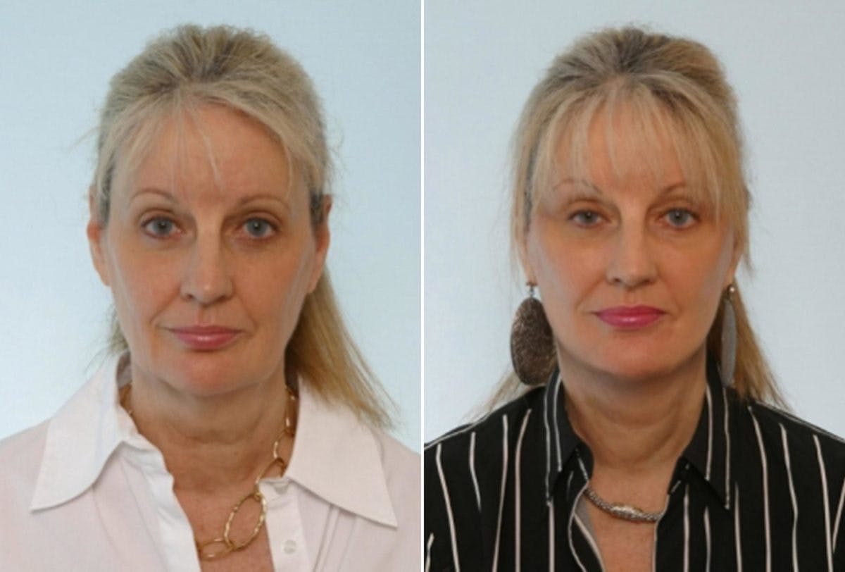 Facelift Before & After Gallery - Patient 55119249 - Image 1
