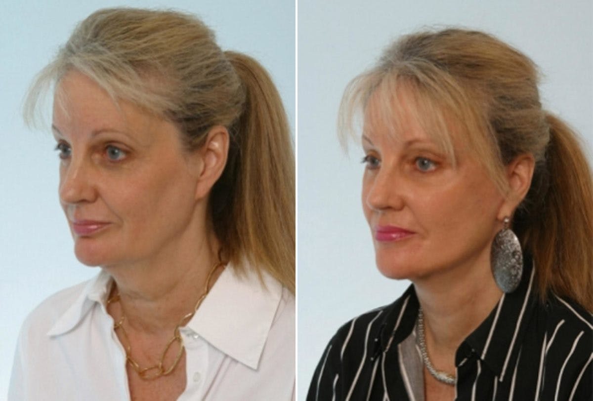 Facelift Before & After Gallery - Patient 55119249 - Image 4