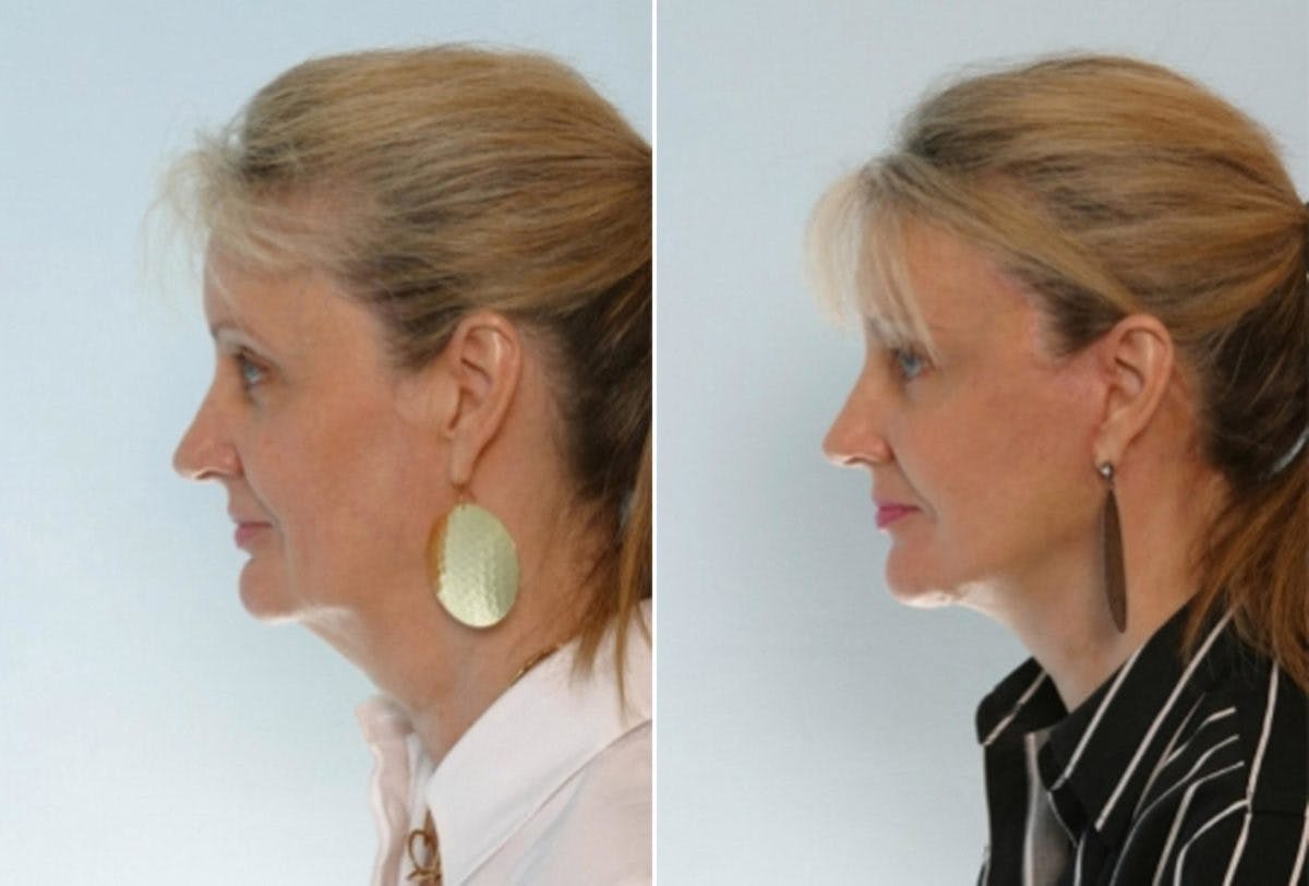Facelift Before & After Gallery - Patient 55119249 - Image 5