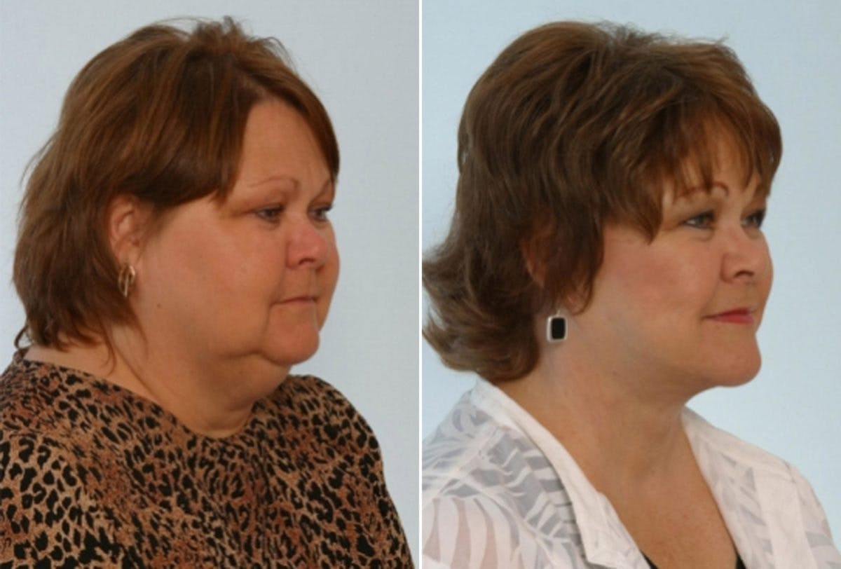Facelift Before & After Gallery - Patient 55119250 - Image 2