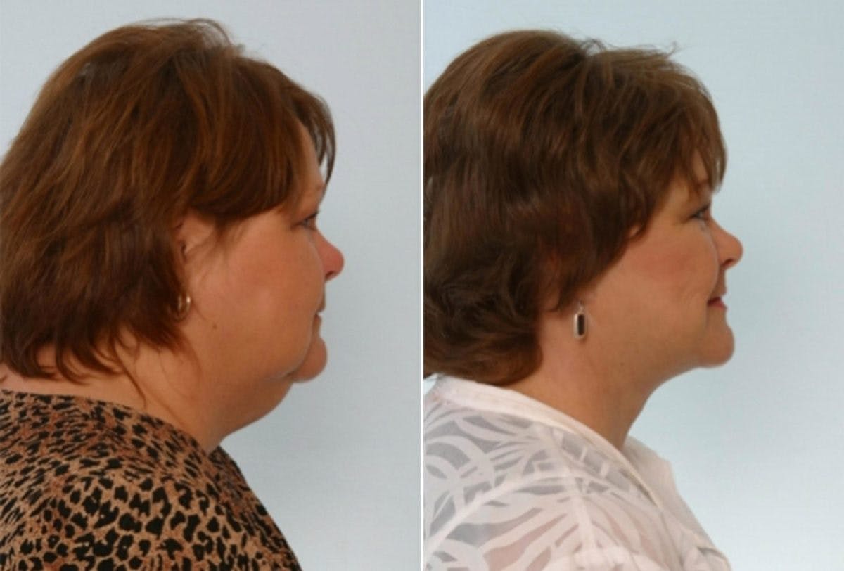 Facelift Before & After Gallery - Patient 55119250 - Image 3