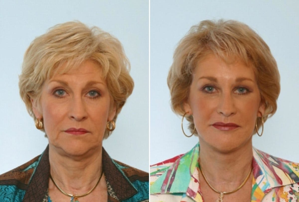 Facelift Before & After Photo - Patient 55119252 - Image 1