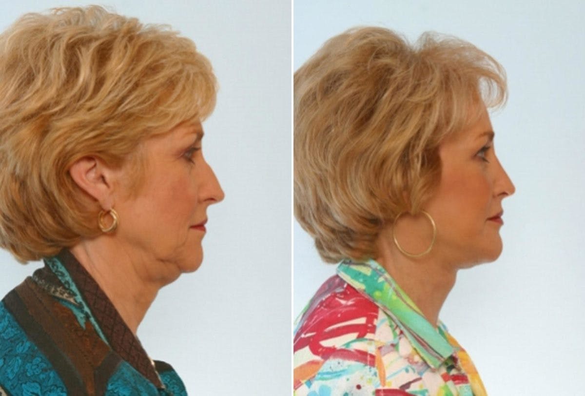 Facelift Before & After Photo - Patient 55119252 - Image 3