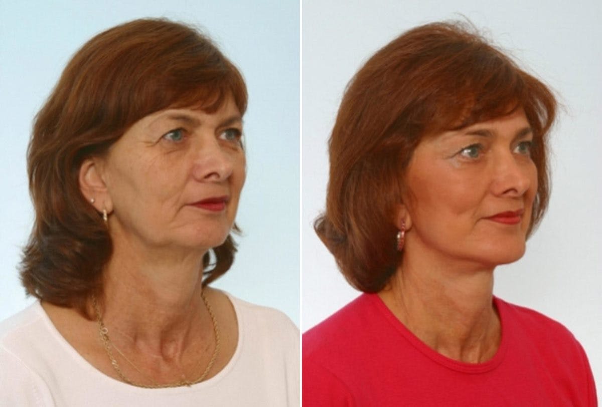 Facelift Before & After Gallery - Patient 55119253 - Image 2