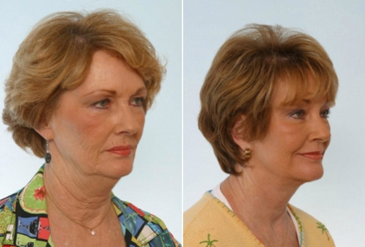 Facelift Before & After Gallery - Patient 55119254 - Image 2