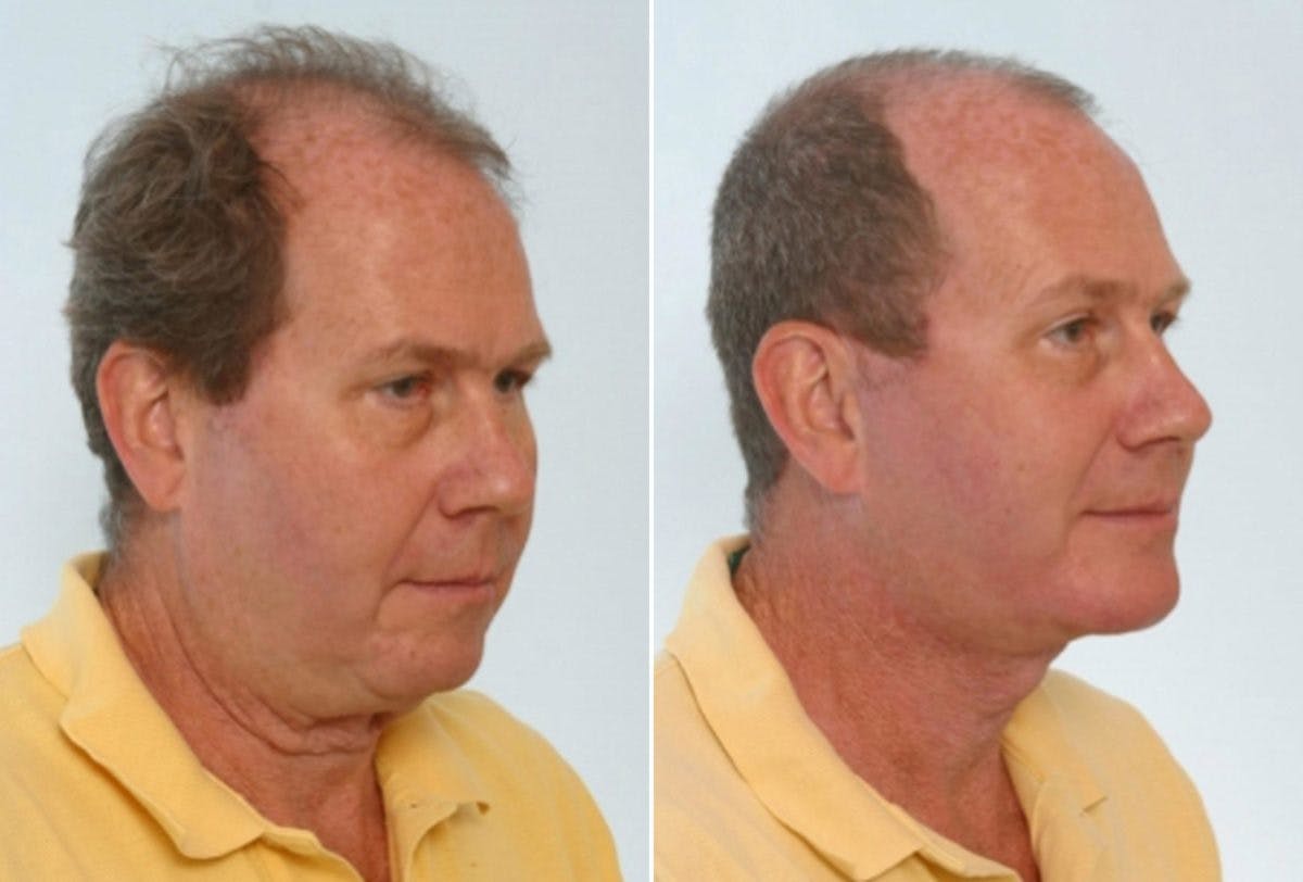 Facelift Before & After Gallery - Patient 55119255 - Image 2