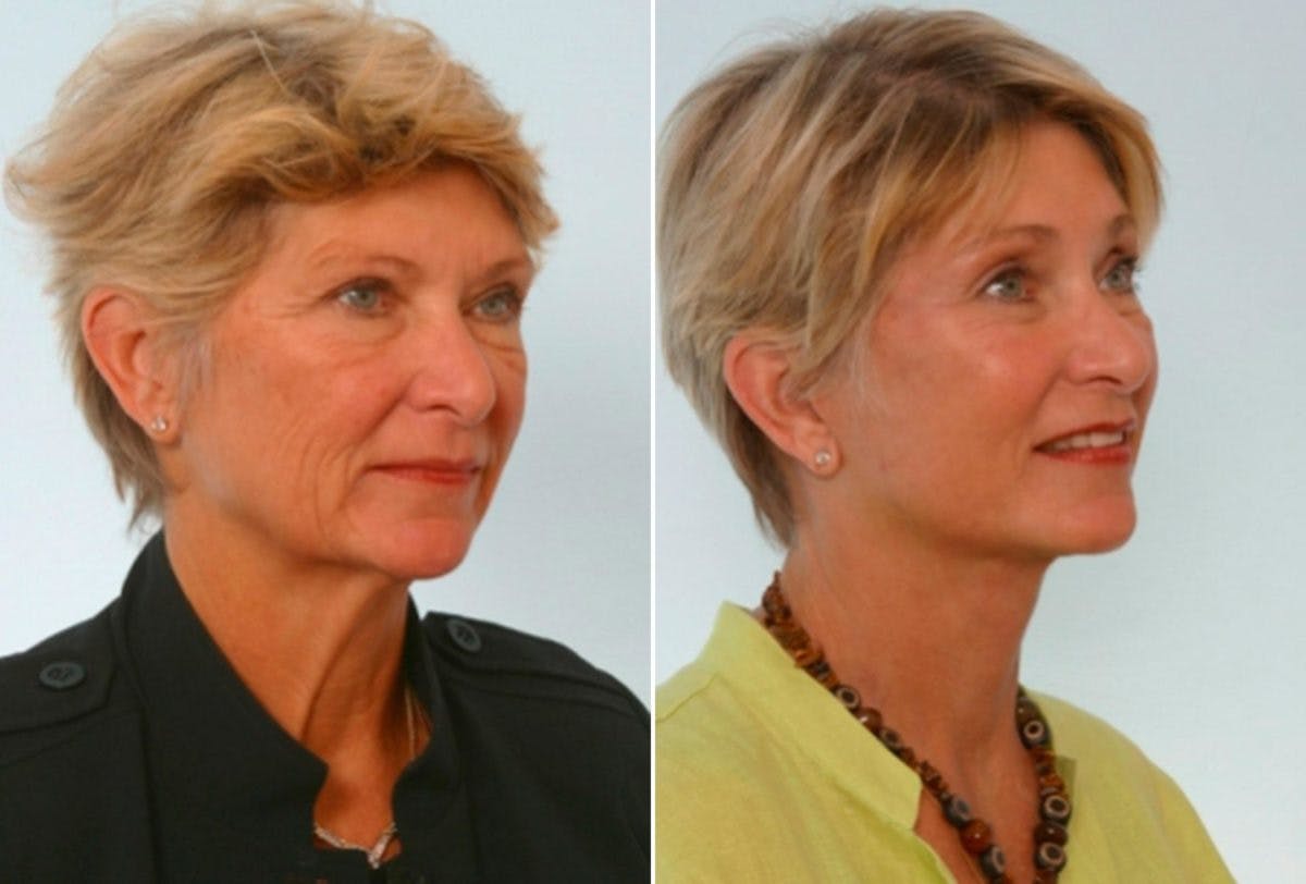 Facelift Before & After Gallery - Patient 55119258 - Image 2