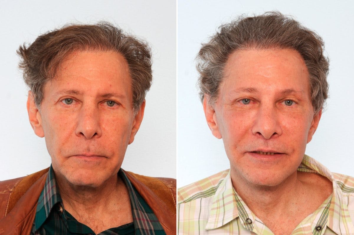 Fat Grafting Before & After Gallery - Patient 55119263 - Image 1