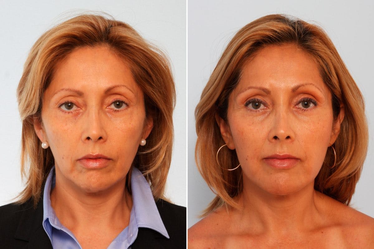 Fat Grafting Before & After Gallery - Patient 55119266 - Image 1