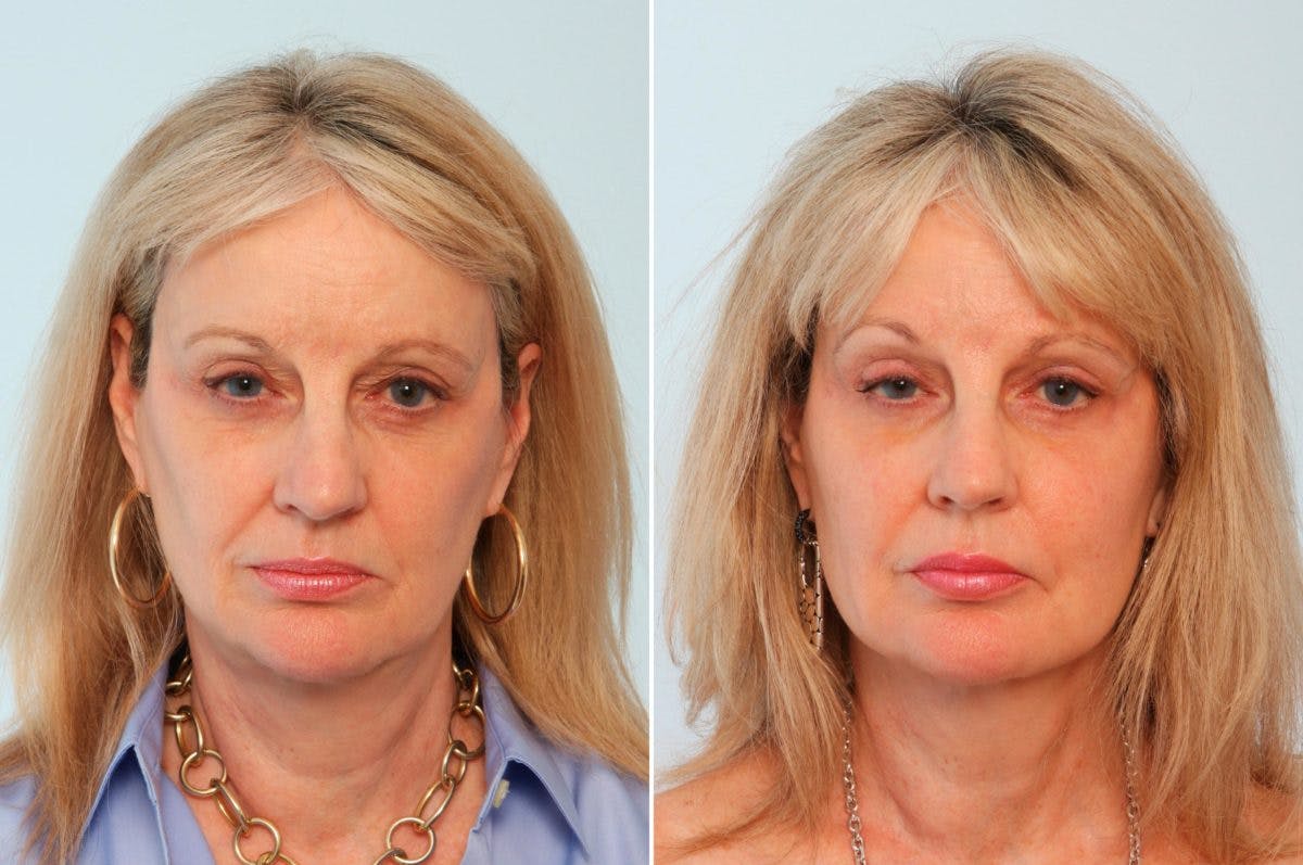 Fat Grafting Before & After Photo - Patient 55119270 - Image 1