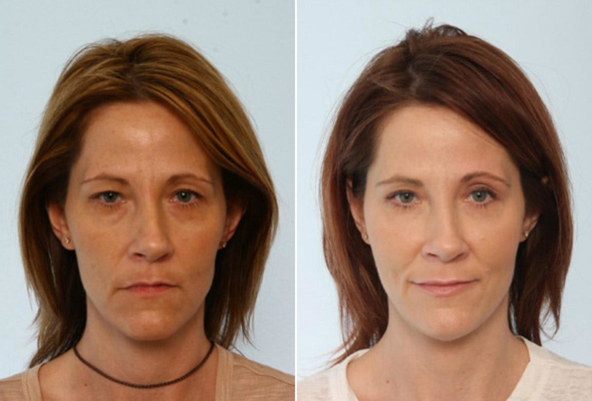 Fat Grafting Before & After Gallery - Patient 55119273 - Image 1